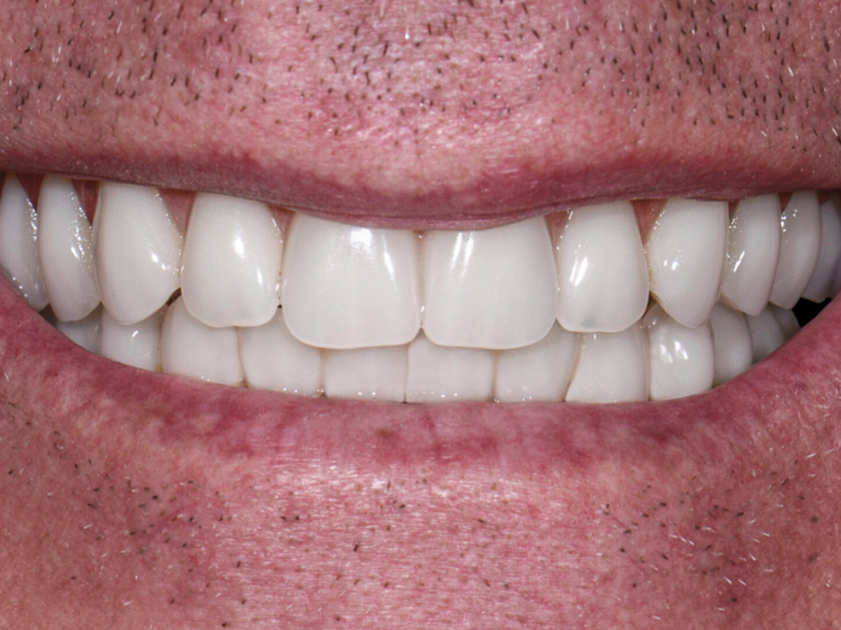 All-On-4-Dental-Implants-Restoring-Smiles