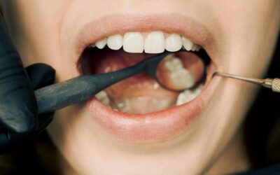 When Wisdom Teeth Go Rogue – Common Issues and Complications